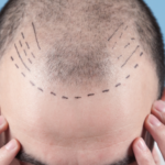 hair transplant in shimla