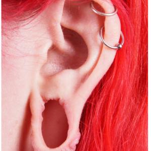 Ear lobe repair