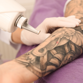 tattoo Removal in shimla