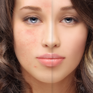 Acne laser treatment by oasis clinic shimla