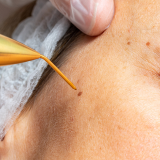 Skin tag and wart removal at oasis clinic shimla