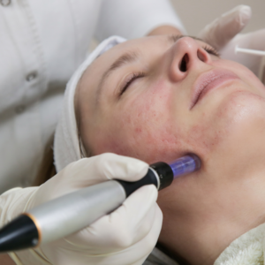 Microneedling at oasis clinic shimla