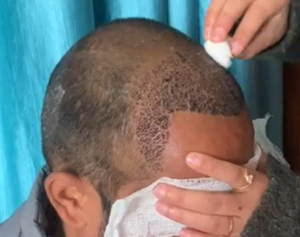 hair transplant in oasis